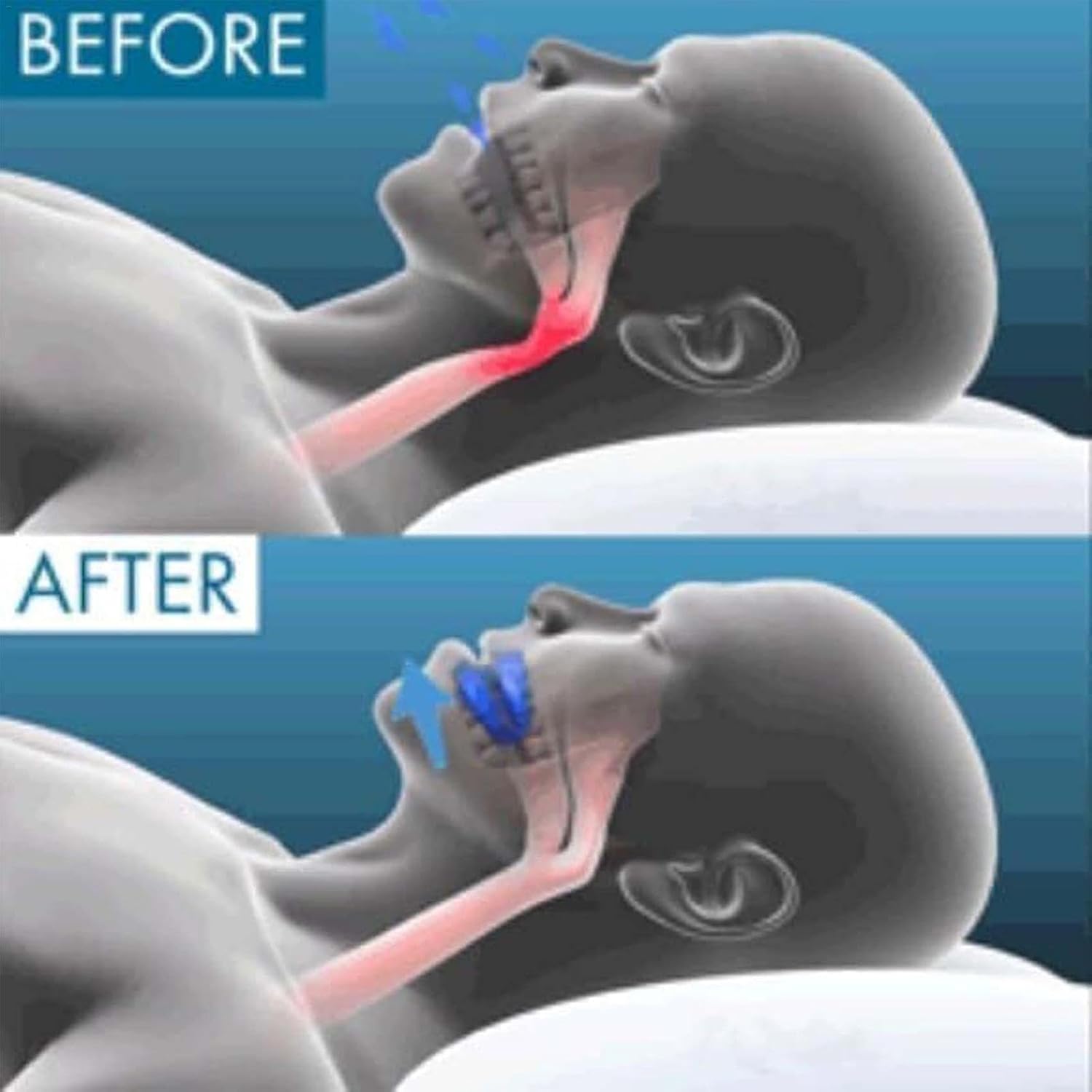 Orthèse buccal Anti Ronflement