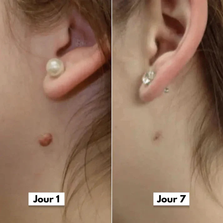 SEFUDUN™ – La solution pratique pour prendre soin des acrochordons à domicile